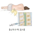 매독 이미지