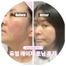대의사우나 | 압구정 피코슈어 듀얼 레이저 토닝으로 기미 잡티제거 후기