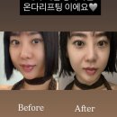 내가좋아하는 | 청담피부과 추천 - 내가 젤 좋아하는 온다리프팅 온다후기 ♥