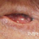 코리아의안센터 티스토리