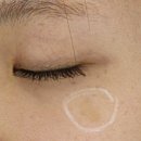 ʚ 성인 밀크반점 치료기(10회차 후기) 재발 부작용ɞ
