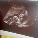 우리항외과의원 | 차부터 임신 36주차 까지, 임산부 일상 증상 머리 큰 아기 치골통 치핵 몸무게정체 만삭 임산부 리얼 후기