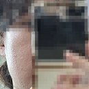 닥터약국 | 모낭염 연고 추천-닥터 예스키놀 젤 3일 사용후기,약국 추천템