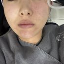 애프터스킨 | 분당피부과 통증 없는 스킨부스터 셀르디엠 경기도분당 시술 후기 비포애프터