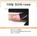 Pes Anserine Bursitis 이미지