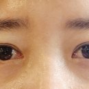 팝성형외과의원 | [내돈내산] 팝 성형외과 12홀 자연유착 쌍꺼풀 재수술 두 달 차 후기 (쌩얼 전후 사진!!)
