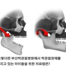 [부산턱관절병원] 턱관절장애 그대로 방치하면 아이 성장발달에 악영향 이미지