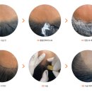 명암1길 | [헤어라인] 콤플렉스 해결! M자 이마 커버하는 헤어라인 시술 후기