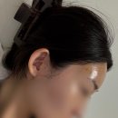 아프지마 약국 | 천호역 성형외과 이마필러 자연스럽게 국산 채움 필러 4cc 내돈내산 후기 (울퉁불퉁하다 울퉁불퉁한)