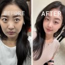 서울아트라인의원 | 청담 스컬트라 후기 볼패임부터 입아래 꺼짐까지 얼굴라인 개선 브랜뉴의원