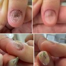 역삼중앙 | 역삼역 네일샵, 손톱 곰팡이균 해결 후기