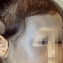 얼굴의 반 이상을 차지하며 피부암으로 까지 발전할 수 있는 난치성 질환은? 이미지