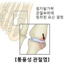 통풍(Gout) 이미지