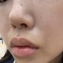 코스킨 | 스킨보톡스 후기 코 인중 땀 억제 효과 시기 통증