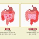 궤양성 대장염 증상 혈변 원인 치료 약 이미지