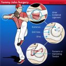 자가운동 표준 프로그램 | 척골측부인대 재건술(Ulnar Collateral Ligament Reconstruction)임상 연구 : 토미존 수술과 재활