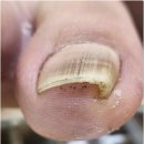 배곧내성발톱 세심하고 꼼꼼하게 잘하는 곳 배곧 네일포유
