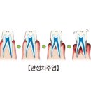 만성 치주염, 치조골염, 충치 이미지