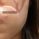 (주)스킨앤바디 | 연산동에스테틱 여드름 압출 퀵트로이필 피오니스킨앤바디 내돈내산 후기