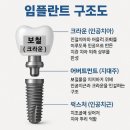 스마튼병원 | 과정 03-[임플란트 3개, 크라운 신경치료,치아보험 청구] 임플란트치료 6개월소요, 크라운 임플란트후기