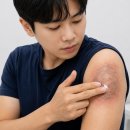 홍대역문신제거, 지우고 싶을 때 알아야 할 3가지