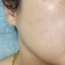 이솔케어 | 이솔에스테틱 남악잡티제거 잡티제거후기