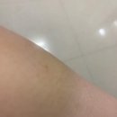 August31 | [2025.August.31] 편도수술 12일차 후기_식단/통증/음식/변비/입맛