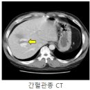 간 혈관종(Hemangioma) 이미지