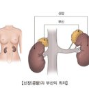 신부전증 증상 및 원인과 치료 급성 만성 말기 포함 이미지