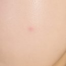 바른카 | 압출 후 관리템 찾는다면? 바르는 여드름 패치 픽시카 후기