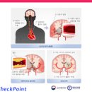 뇌졸증 원인과 치료 뇌졸증의 날 뇌졸증을 줄이는 방법과 비만과의 관계 이미지