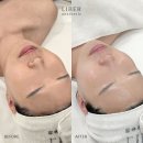 맑고 아름다운 피부 | 수원 신부관리 추천! 트리플 토닝으로 완성하는 맑고 깨끗한 피부 예비신부 리얼 후기