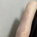 365엠씨람스의원 | 람스/지방추출주사/일반람스 내돈내산 찐 후기/시술사진 o/꿀팁o