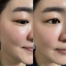 고양피부과 리쥬란힐러 후기｜고양리쥬란힐러 더마샤인으로 받은 후기