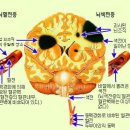 중풍이 오기전에 나타나는 증상들 이미지