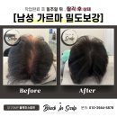 도트인스칼프 이미지