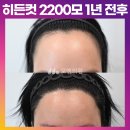 [20대 여자 헤어라인 교정 M자 머리 심기] 비절개 히든컷 2200모 1년 후기 (모엠의원/헤어라인/전지훈원장) 이미지