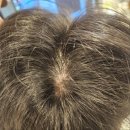 수원-2007 | [영통두피관리] 수원탈모, 지루성두피관리 두피밥 수원점 방문 후기