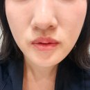 베이스피부과의원 | [청담피부과의원] 티타늄3주차후기 비포애프터 리세티 리프팅