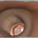 메아리 보청기 이미지