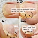 부원프라자 | 잘못 받아온 패디케어 교정관리중 - 의정부 엄지발톱 통증 전문가 은영 부원장