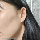 두앤두뷰티센타 | 천안여드름관리 성성동 두앤두 뷰티센터, 플라즈마 피지제거 후기