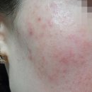 리유한의원 | 리유한의원 후기 주사피부염 재발 없이 치료함