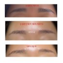 [인천 눈썹문신제거 1회차 리얼 후기]성형외과, 피부과 병원 제거/내돈내산/문신은 신중하게../비포...