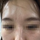 안암한의원 | 급성두드러기 치료 (3) 한약 양약을 병행한 리얼 후기