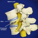 kyphoplasty-Osteoporosis Fracture 이미지