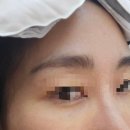 옳은손성형외과 | [내돈내산]눈밑지방재배치(지방이식×),눈밑지 후기