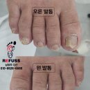 레푸스남양주다산점 | 레푸스 남양주 다산 무좀발톱 관리후기 딸과 사위의 결혼식전 어머니께 드리는 선물