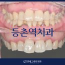 등촌역치과 앞니가 깨지고 잇몸에 통증이 있어요