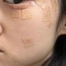 씨지에프 | 분당 편평사마귀 제거 내돈내산 후기 (100개 비용, CO2 레이저 사후관리 꿀팁)